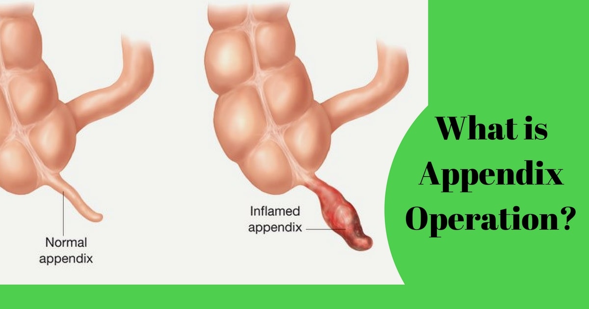 Three Examples Of Health Care Expenses After Surgery For Appendicitis