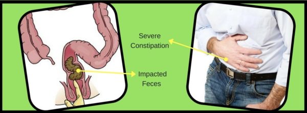 Appendix Removal Surgery In Chennai Dr Maran Appendix Surgeon