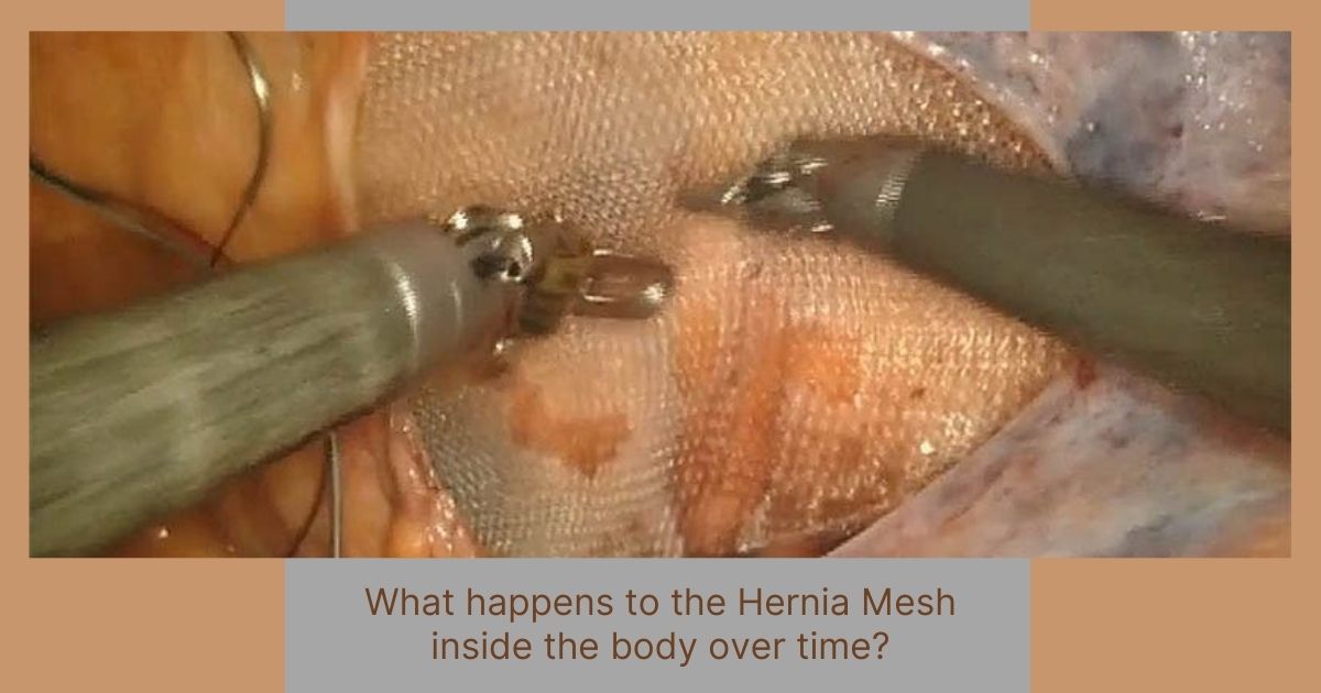 What happens to the Hernia Mesh inside the body over time?