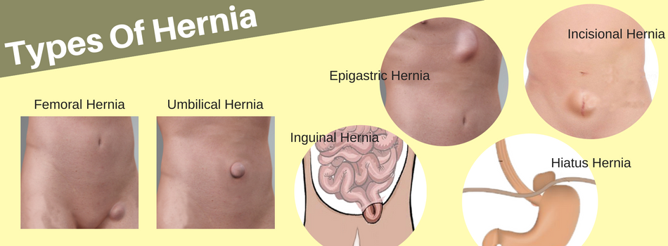 are there different types of hernia