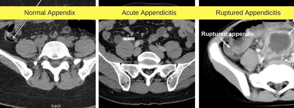 Appendix Removal Surgery In Chennai Dr Maran Appendix Surgeon