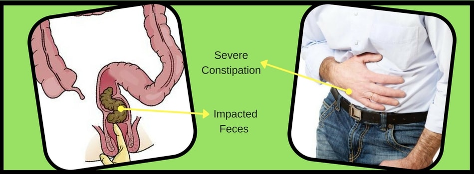 No Bowel Movement After Appendix Removal