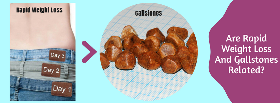 gallstone-and-rapid-weight-loss-dr-maran-gastro-surgeon