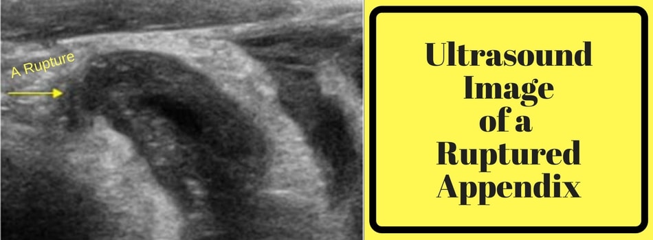 Appendix Removal Surgery In Chennai Dr Maran Appendix Surgeon