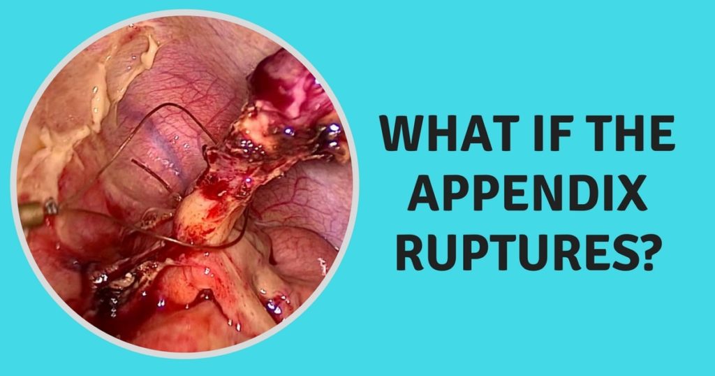 Image showing a ruptured appendix that is removed and that region is cleaned during a appendix surgery in Chennai to prevent infection.
