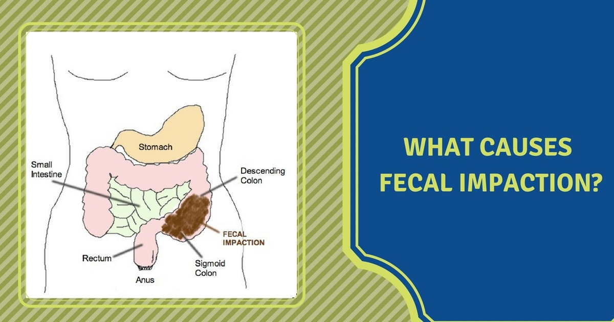 Diagram of digestive system used in faecal impaction cause & treament explanaton by Dr Maran M.