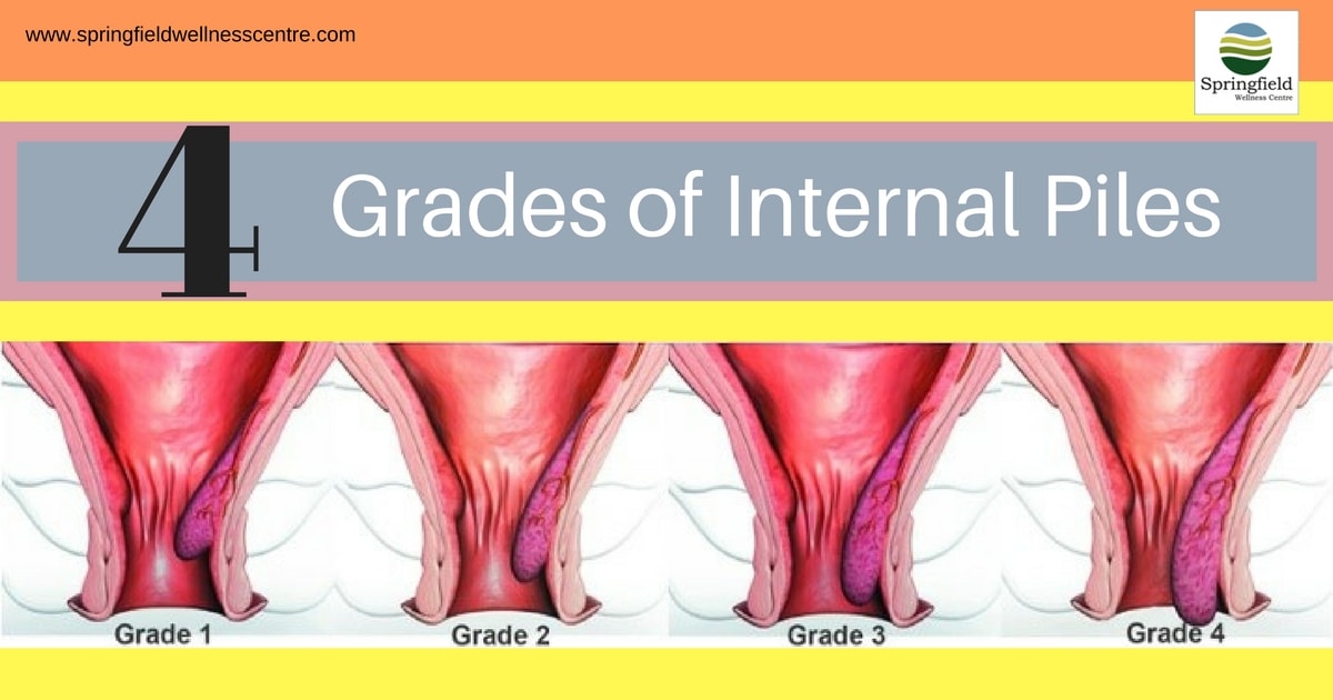 This image is used to explain the four various grades of internal piles by Dr Maran M, leading surgeon in Chennai.