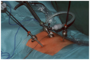 Inguinal Hernia Surgery is done by Hernioplasty or Herniorrhaphy. Hernioplasty by Laparoscopy and placing mesh.