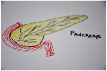 Acute Pancreatitis