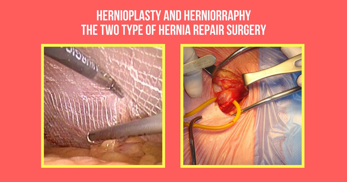 Hernia Treatment & Surgery in Chennai