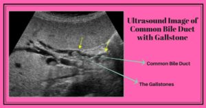 Ultrasound image showing common bile duct with gallstones. Dr. Maran tells that gallbladder needs to be removed by surgery.