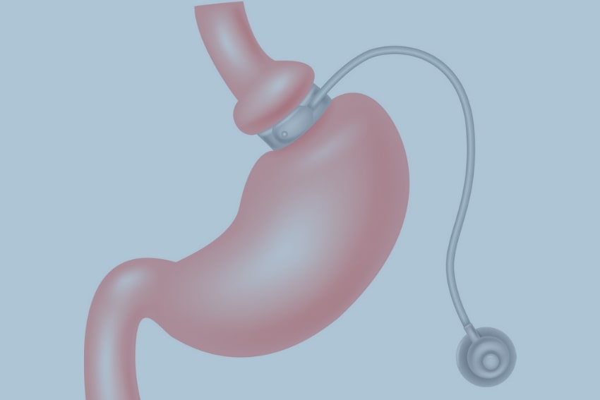 In gastric banding bariatric Surgery in which the food intake in limited as a band is placed around the stomach pouch.