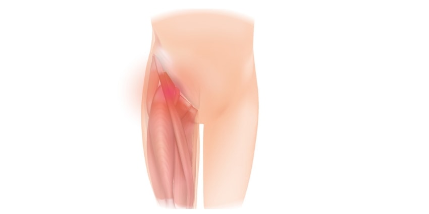 Pain in the groin is a symptom if inguinal hernia is present. Inguinal Hernia Surgery is also a Hernia repair surgery.