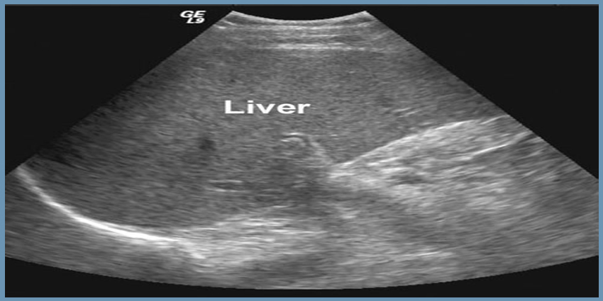 liver stone