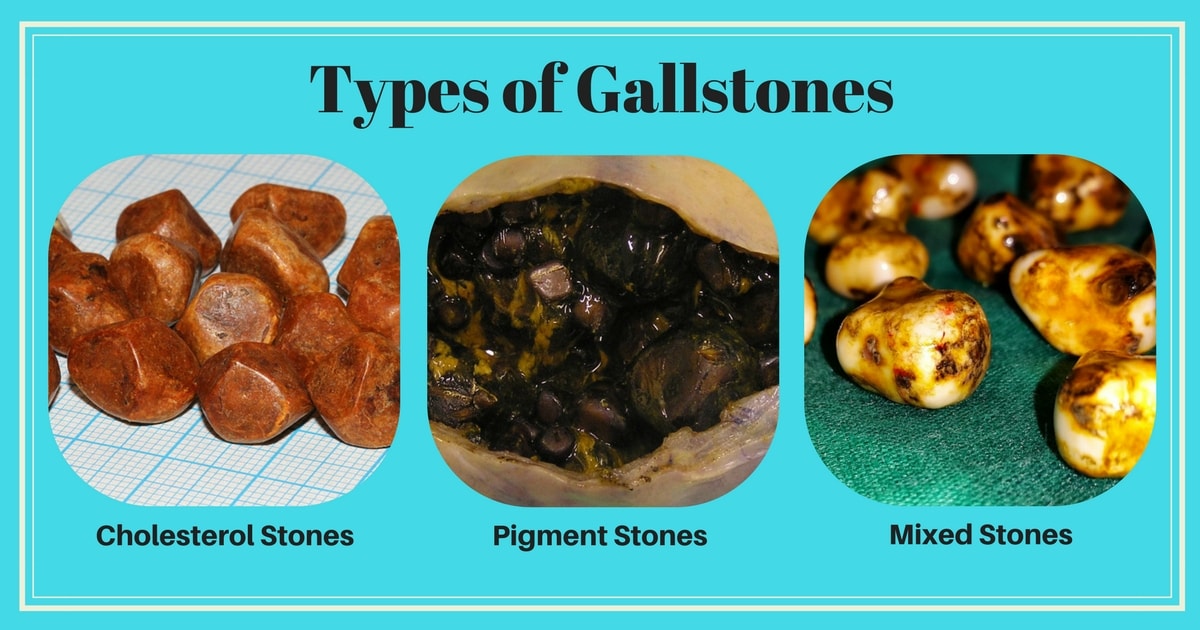 Gallbladder Removal Surgery in Chennai | Gallstones Treatment