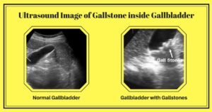 Ultrasound showing normal gallbladder vs gallbladder with gallstones. Dr. M. Maran, the gastro does gallbladder removal surgery.