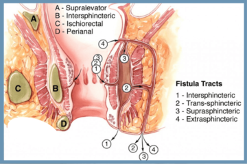 Anal Fistula