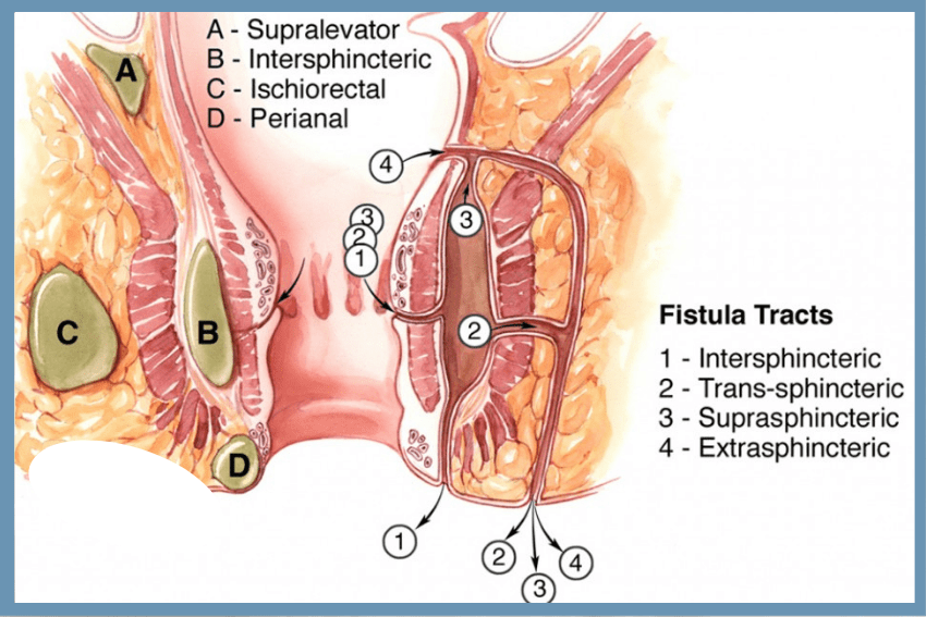 Perianal Abscess Icon Specialist Centre