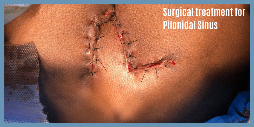 Pilonidal Sinus Symptoms - Pilonidal Sinus Centre