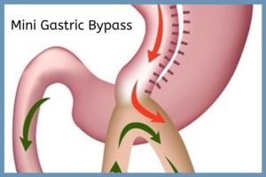 Mini Gastric Bypass in Chennai done by Dr Maran