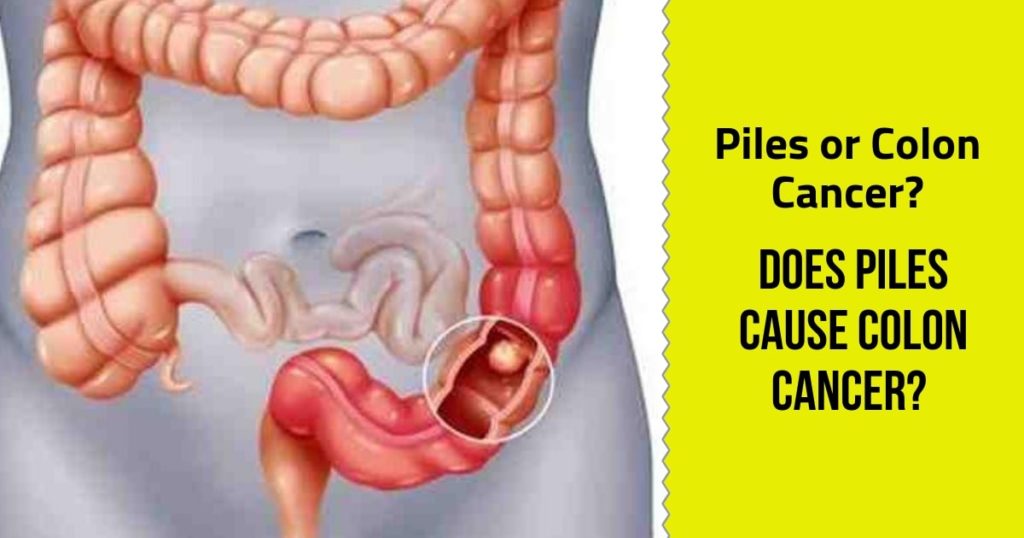 Piles or Colon Cancer? Does Piles cause Colon Cancer - Dr Maran -  Springfield Wellness Centre