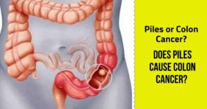 Piles or Colon Cancer? Does Piles cause Colon Cancer - Dr Maran ...