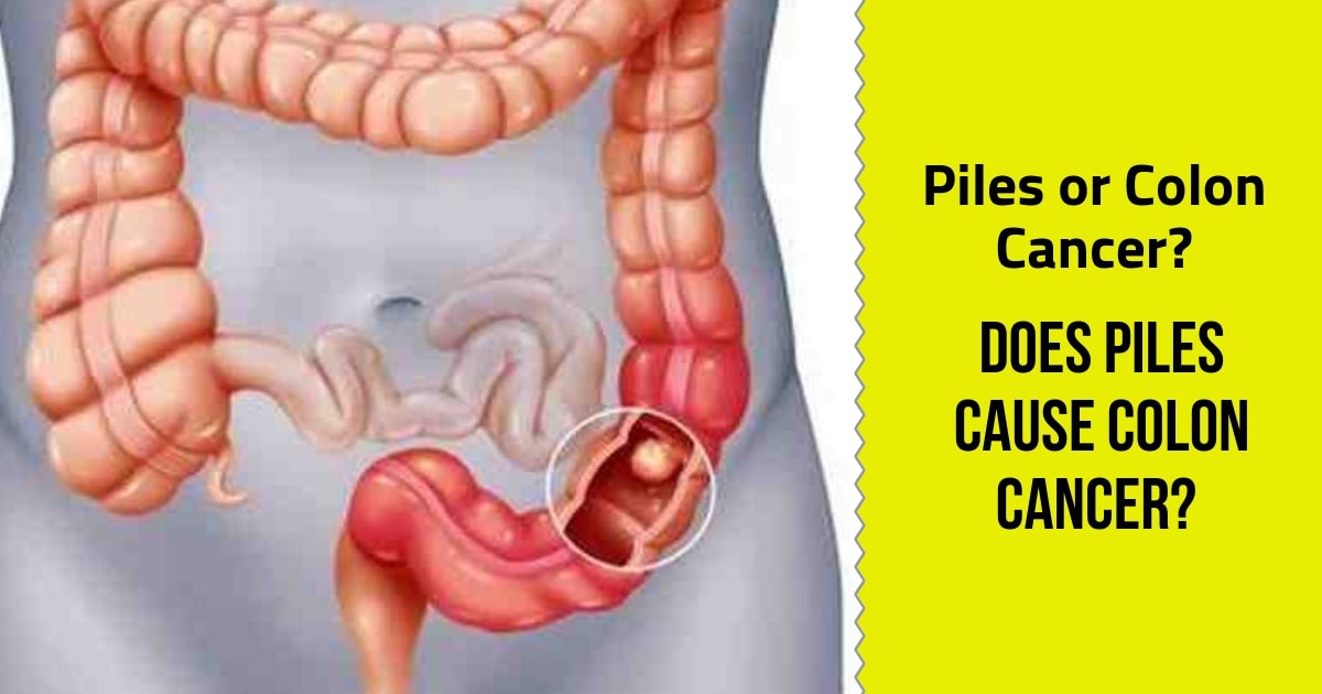 Piles or Colon Cancer? Does Piles cause Colon Cancer Dr