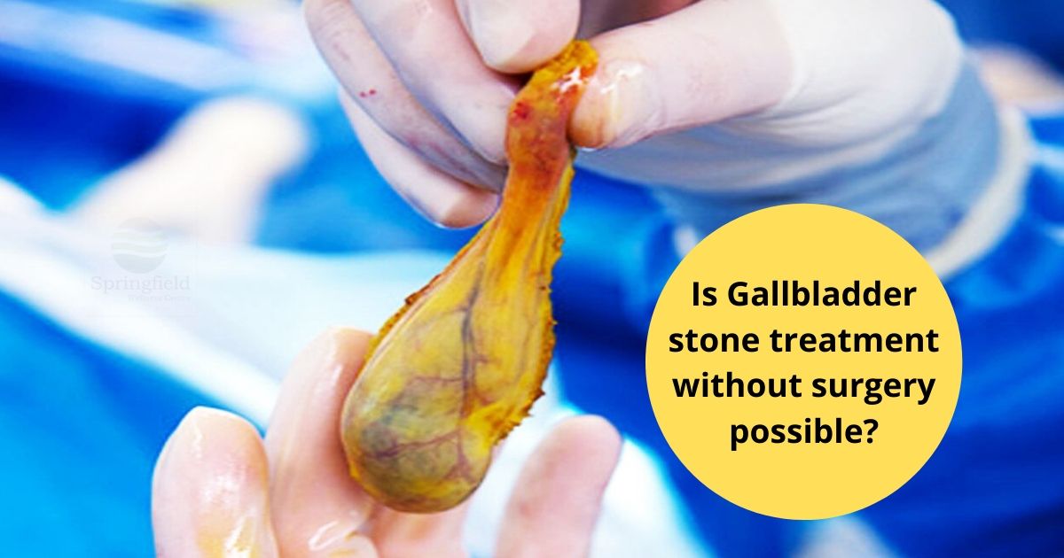 How to Remove Stone from Gallbladder Without Operation 